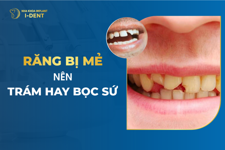 Trám răng cửa bị mẻ được không? Trám răng bị mẻ giá bao nhiêu?