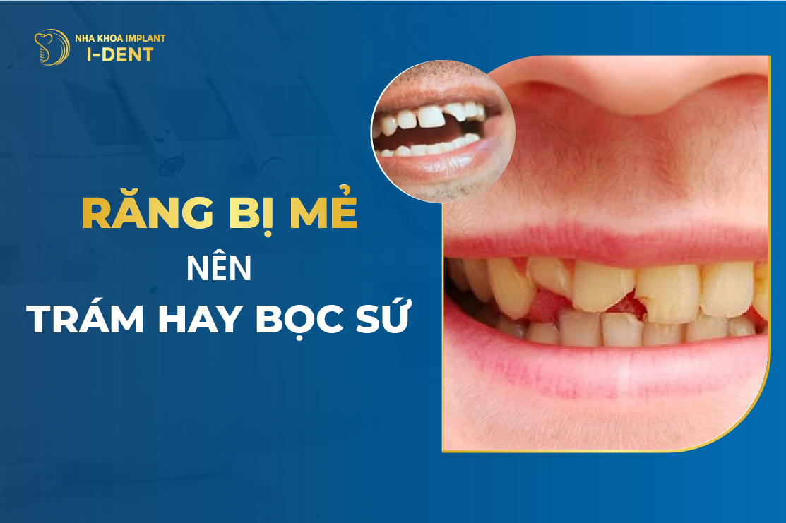 Trám răng cửa bị mẻ được không? Trám răng bị mẻ giá bao nhiêu?
