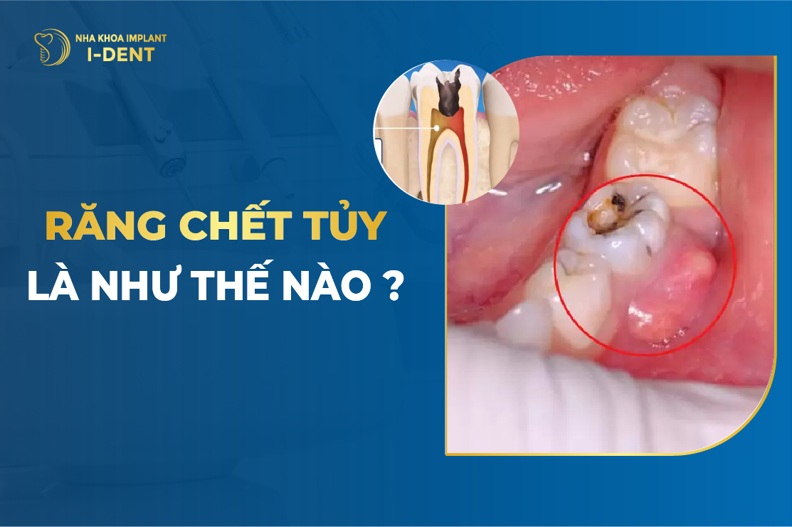 Răng chết tủy là gì? Dấu hiệu, nguyên nhân và cách xử lý triệt để