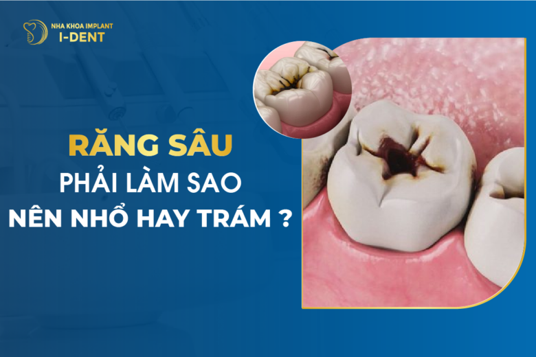 Răng Sâu Phải Làm Sao – Nên Nhổ Hay Trám?