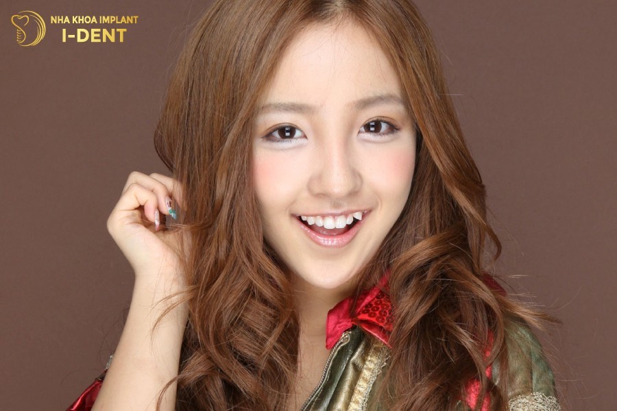 Răng-khểnh-thường-được-xem-là-nét-duyên-ngầm-và-tạo-thêm-sự-dễ-thương-cho-khuôn-mặt