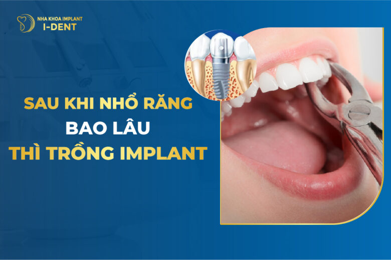 Sau Khi Nhổ Răng Bao Lâu Thì Cấy Implant?