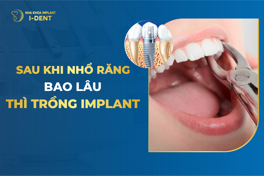 Sau Khi Nhổ Răng Bao Lâu Thì Cấy Implant?