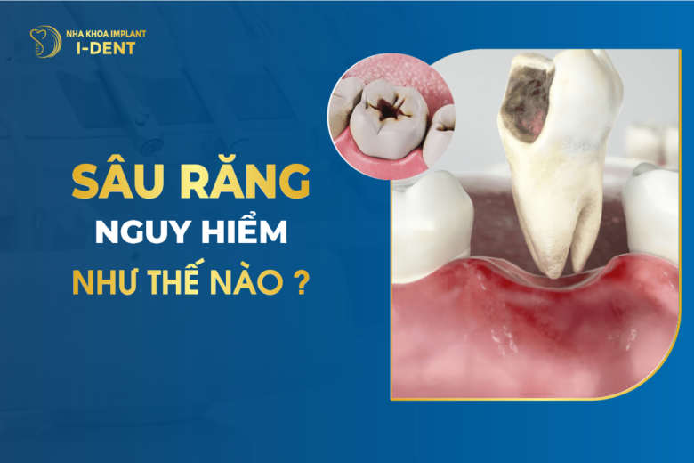Sâu Răng Là Gì? Nguyên Nhân Sâu Răng Và Triệu Chứng Như Thế Nào?