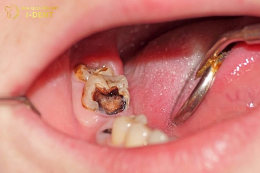 Sau-rang-gay-viem-tuy