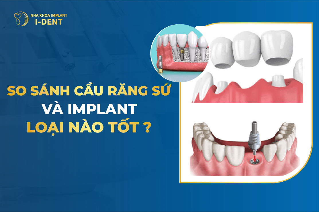 Nên làm cầu răng sứ hay implant tốt hơn?