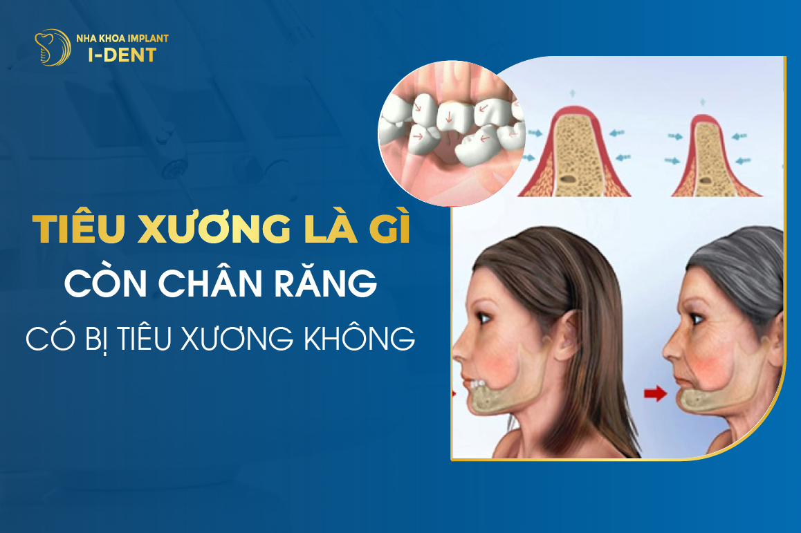 Tiêu Xương Là Gì? Còn Chân Răng Có Bị Tiêu Xương Không?