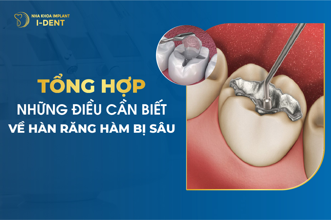 Hàn Răng Sâu Là Gì? Hàn Răng Sâu Có Đau Không?