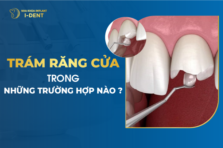 Trám Răng Cửa Trong Những Trường Hợp Nào?