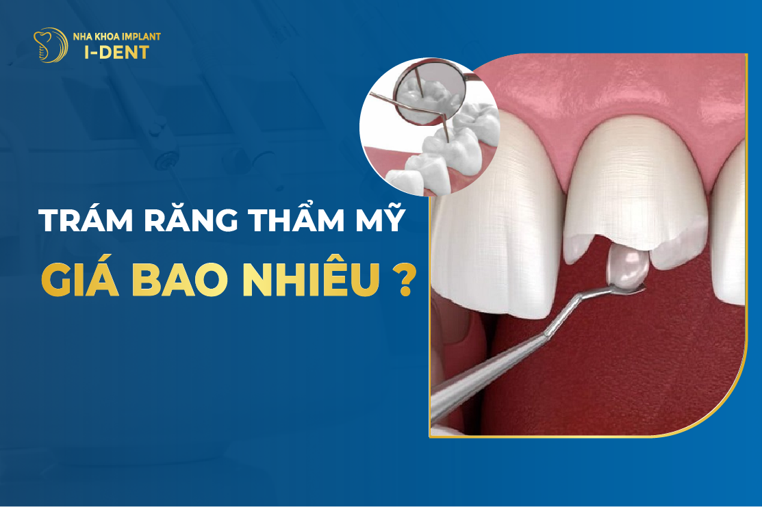 Giá trám răng sâu bao nhiêu tiền? Bảng giá trám răng 2026