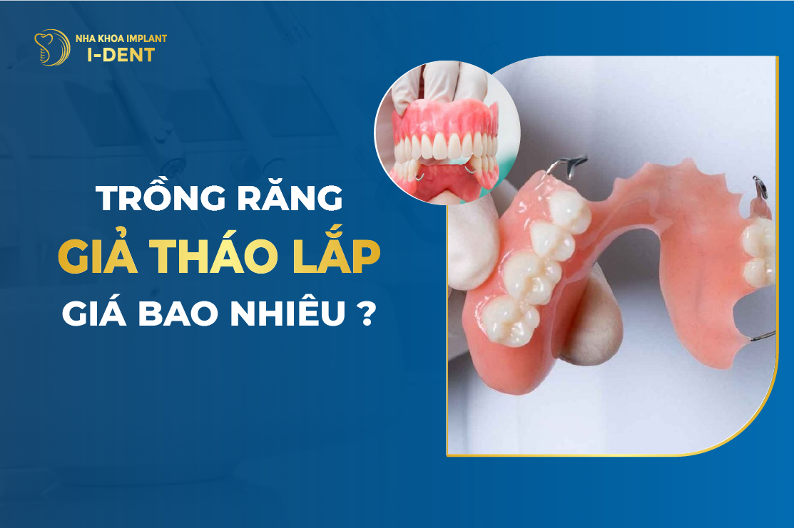 Trồng hàm răng giả tháo lắp: Ưu điểm, nhược điểm và chi phí