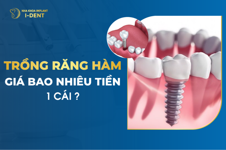 Giá trồng răng giả bao nhiêu tiền? Bảng giá trồng răng 2026