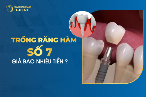 Trồng Răng Hàm Số 7 Giá Bao Nhiêu Tiền?