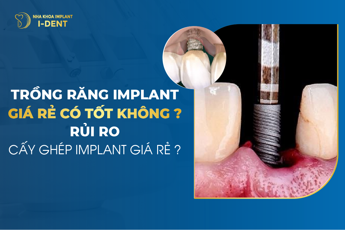 Trồng Răng Implant Giá Rẻ Có Tốt Không? Rủi Ro Cấy Ghép Implant Giá Rẻ