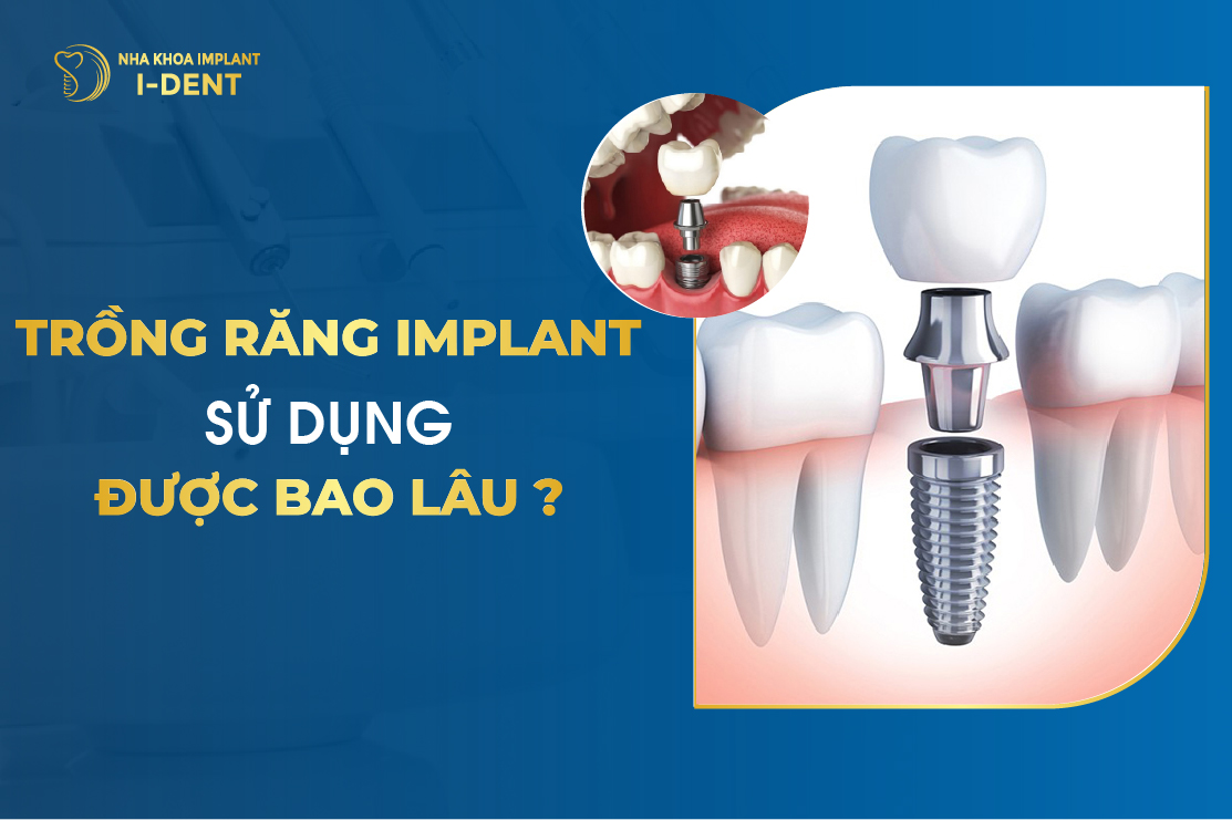 Trồng răng implant được bao lâu? Tuổi thọ vĩnh viễn không?