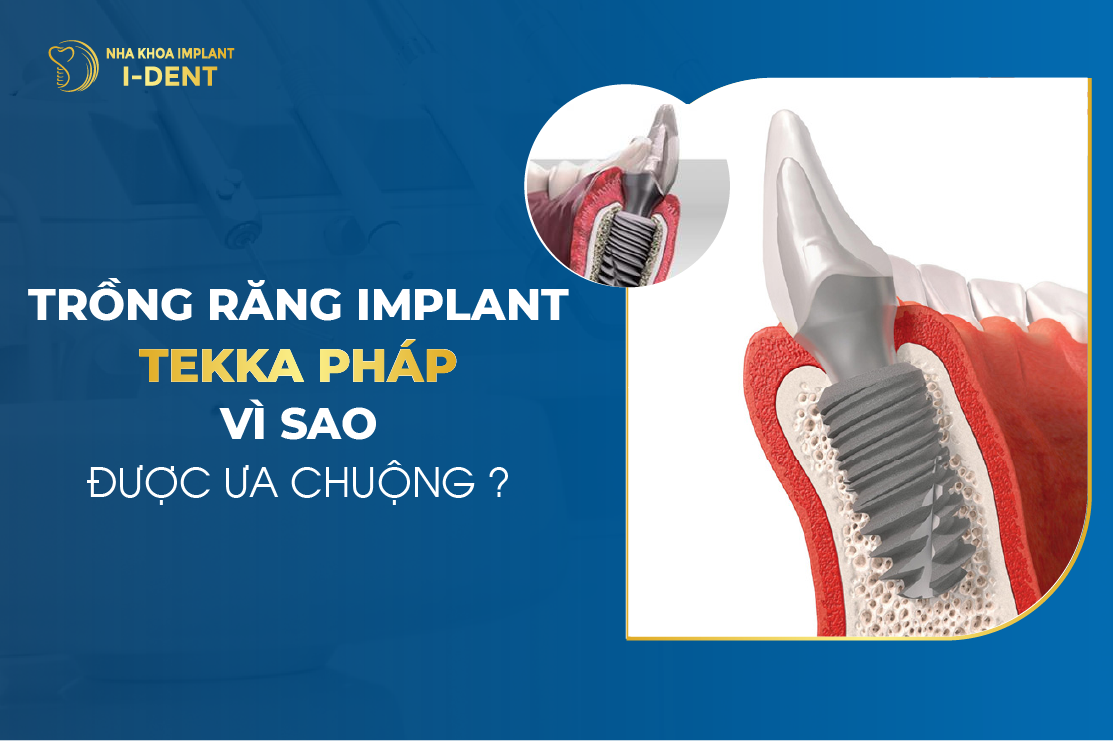 Trụ Implant Tekka Pháp có tốt không? Chi phí bao nhiêu?