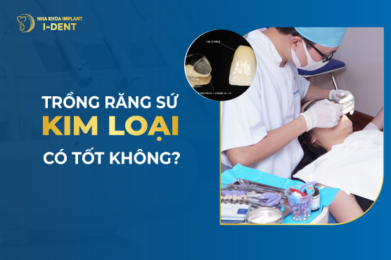 Răng Sứ Kim Loại Là Gì? Có Mấy Loại? Ưu Nhược Điểm