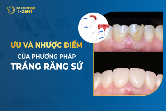 Ưu Và Nhược Điểm Của Phương Pháp Tráng Răng Sứ