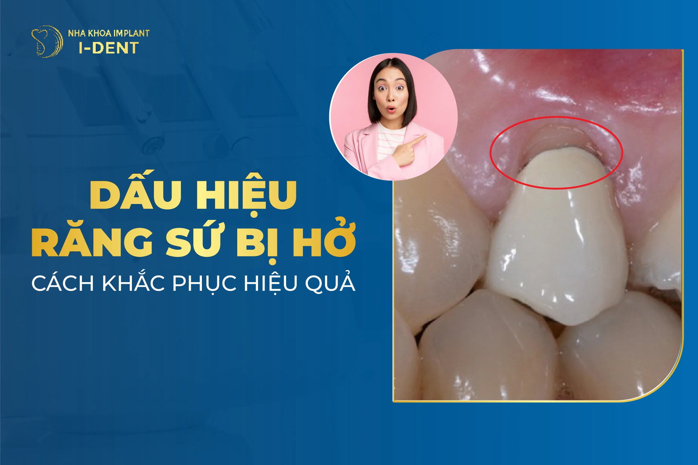 Các Dấu Hiệu Răng Sứ Bị Hở Và Cách Khắc Phục
