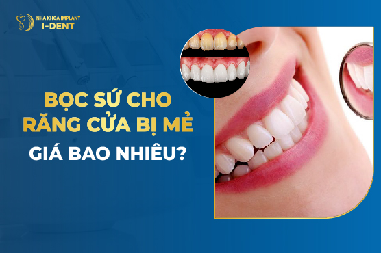 Bọc Sứ Cho Răng Cửa Bị Mẻ Giá Bao Nhiêu?