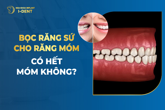 Bọc Răng Sứ Cho Răng Móm Có Hết Móm Không?