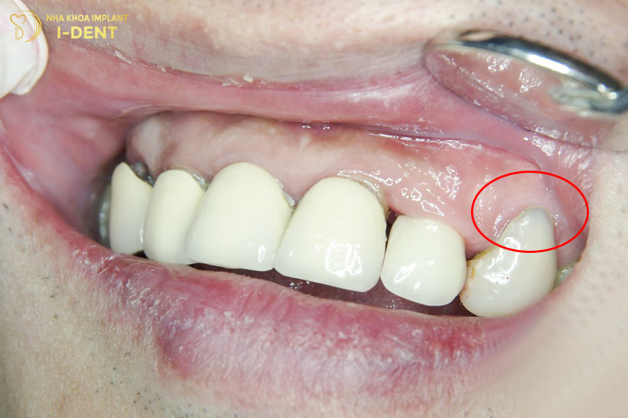 Bọc răng sứ kim loại bị hở dẫn đến răng sứ bị oxy hóa làm xuất hiện vệt đen mờ quanh chân răng sứ.