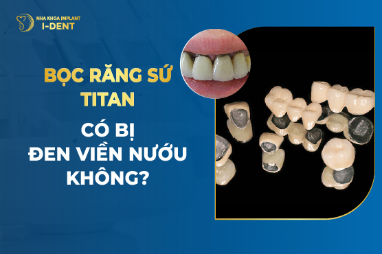 Bọc Răng Sứ Titan Có Bị Đen Viền Nướu Không?