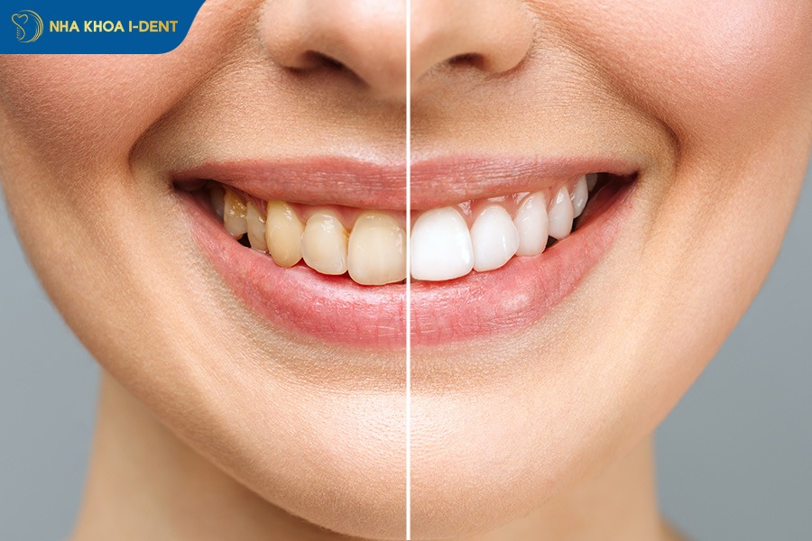 răng sứ có bền không