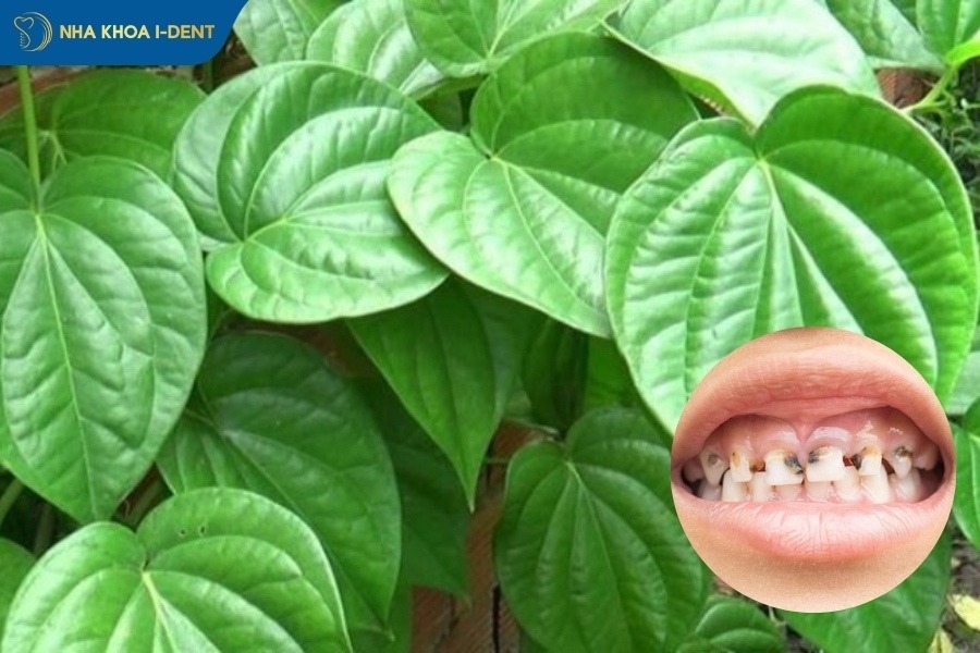 cách chữa sâu răng