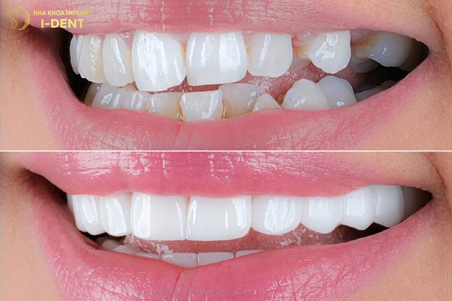 Răng mọc lệch nhẹ được cải thiện rõ rệt sau khi bọc răng sứ. 