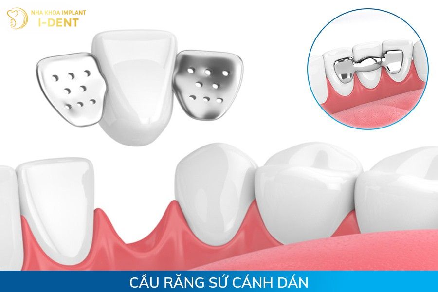 cầu răng sứ là gì