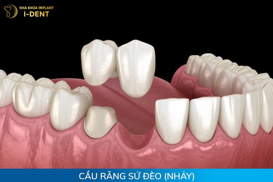 làm cầu răng sứ