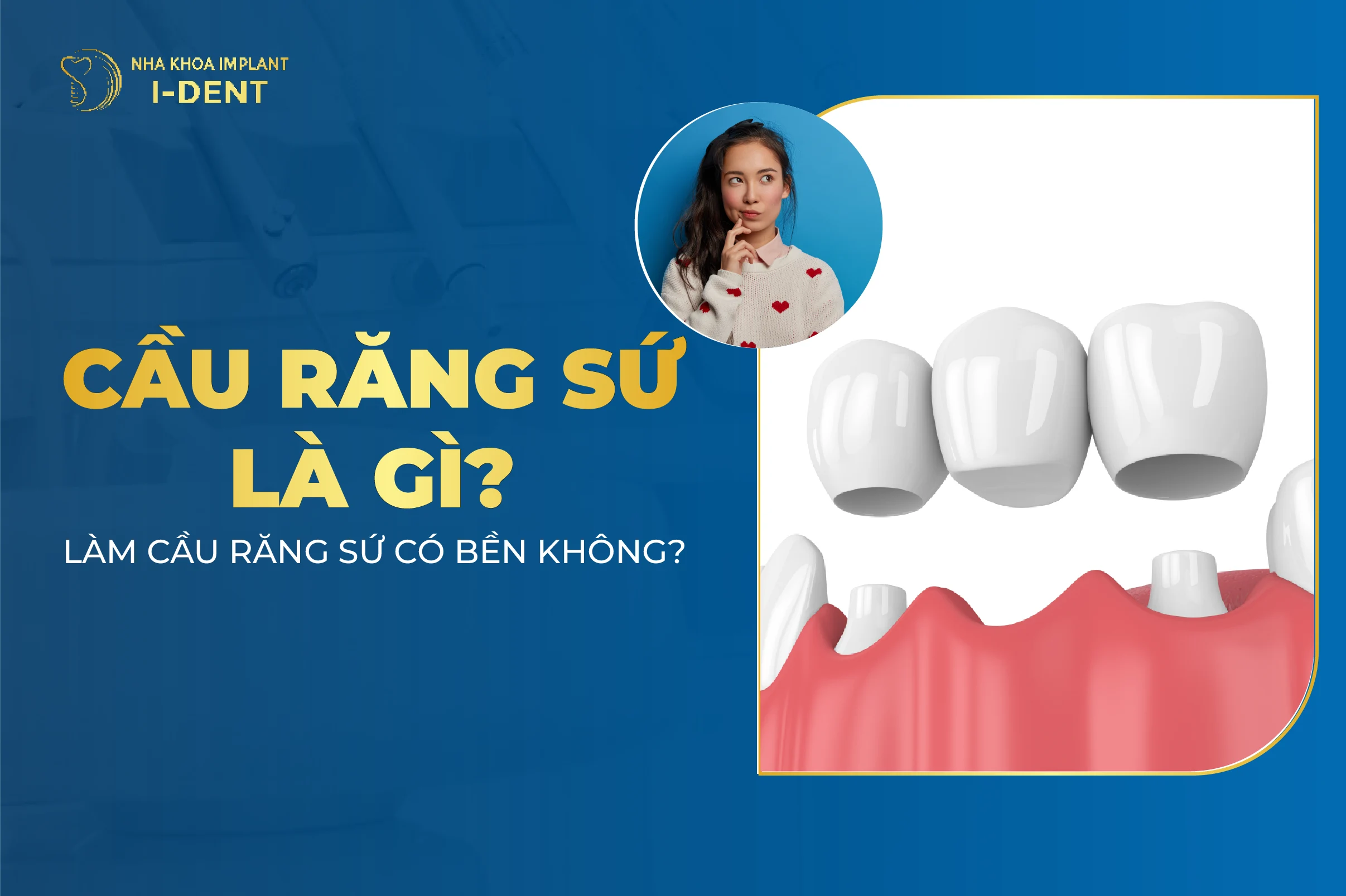 Cầu răng là gì? Ưu nhược điểm của cầu răng sứ