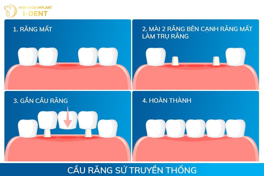 review làm cầu răng sứ