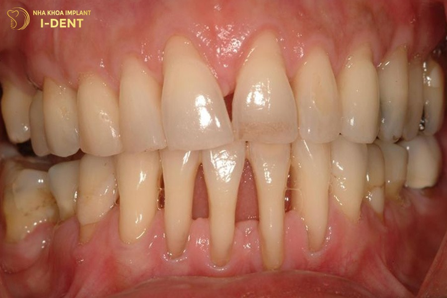 chăm sóc răng sứ không tốt dễ khiến răng thật bị nhạy cảm và yếu đi