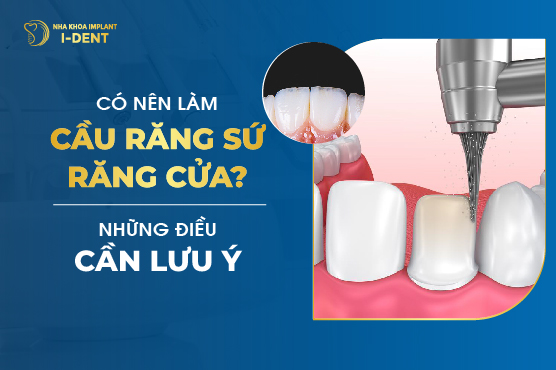 Có Nên Làm Cầu Răng Sứ Răng Cửa? Những Điều Cần Lưu Ý
