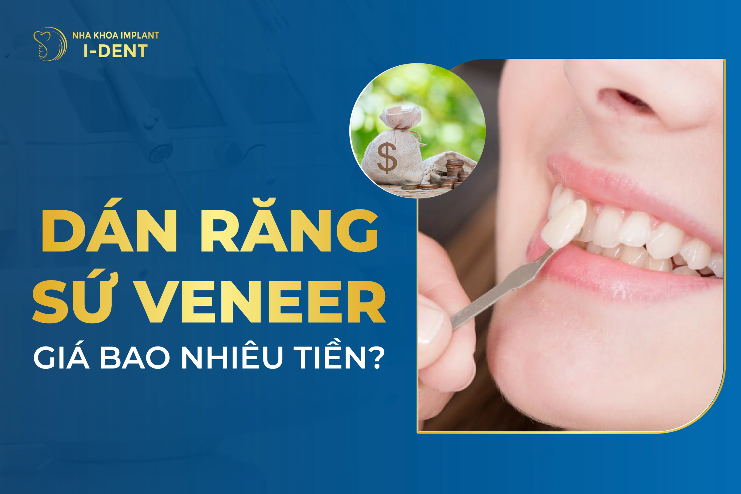Dán Răng Sứ Veneer Giá Bao Nhiêu Tiền? Bảng Giá 2026