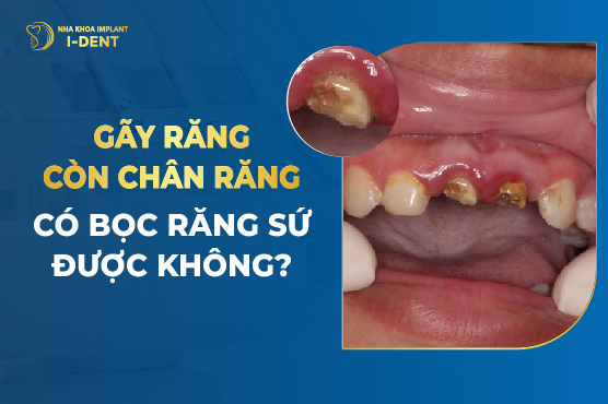 Gãy răng còn chân răng có bọc răng sứ được không?