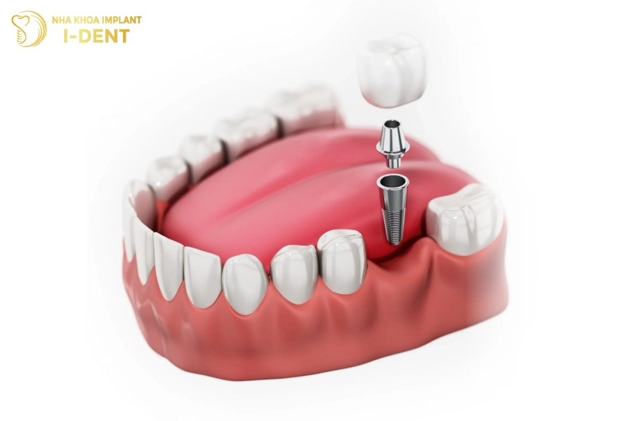 Trồng răng implant có được bảo hiểm không
