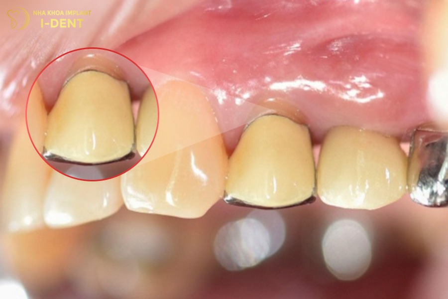 Khe hở giữa vùng chân răng sứ và nướu có thể quan sát bằng mắt thường hoặc dùng lưỡi cảm nhận