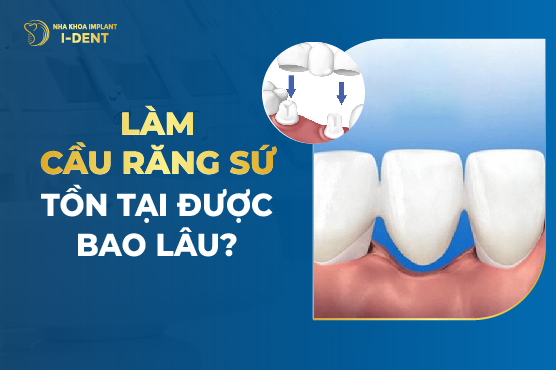 Làm Cầu Răng Sứ Tồn Tại Được Bao Lâu?