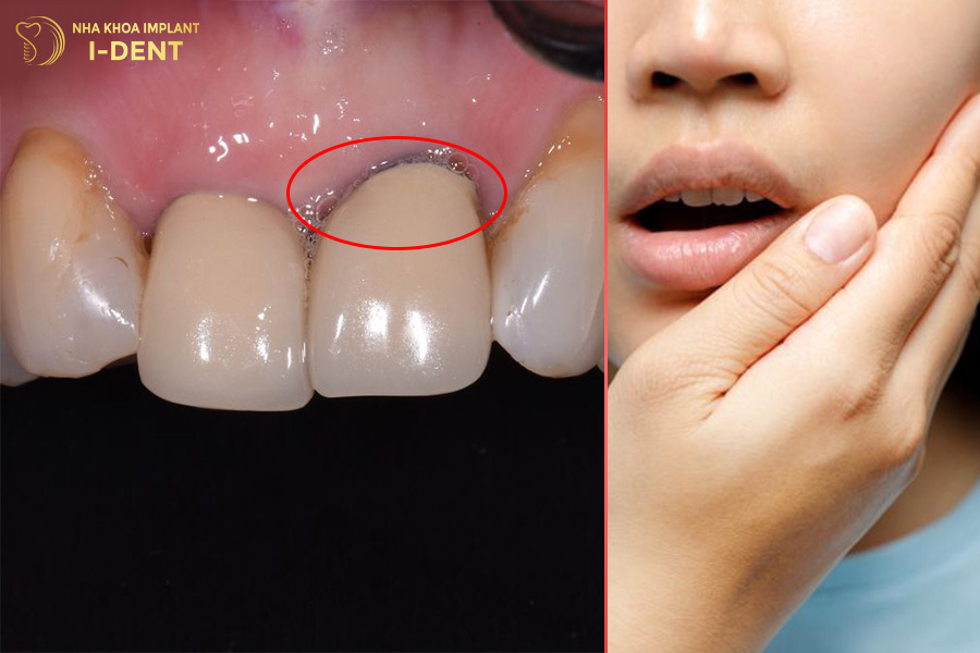 Răng sứ bị hở làm cùi răng bên trong lộ ra, gây ra cảm giác ê buốt và đau nhức khi ăn đồ nóng hoặc lạnh.