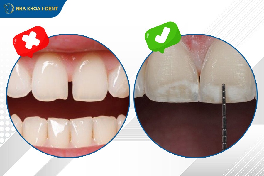 mài kẽ răng để niềng có hại không