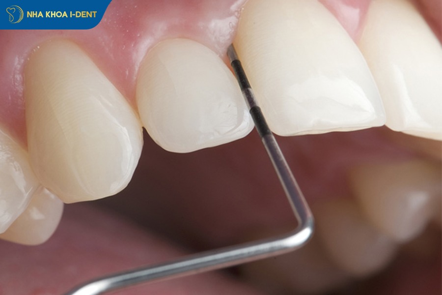 mài kẽ răng để niềng