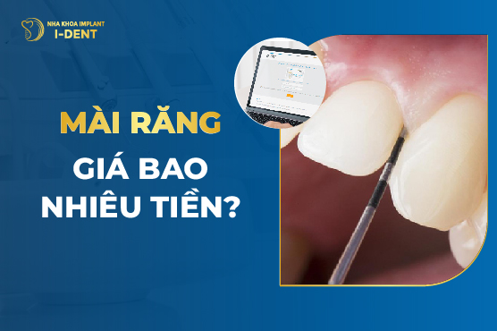 Mài Răng Giá Bao Nhiêu Tiền?
