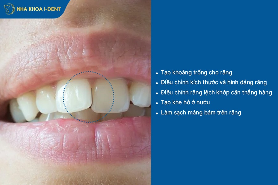 mài răng khi niềng có ảnh hưởng gì không