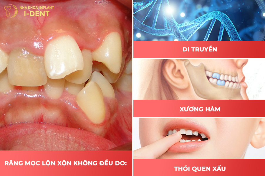 Nguyên nhân khiến răng mọc lệch, mọc lộn xộn. 