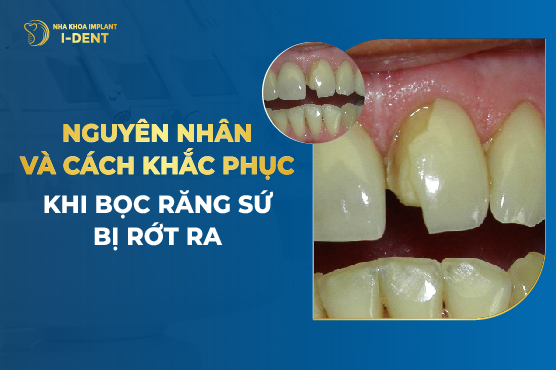 Bọc Tăng Sứ Bị Rớt Ra Không? Phải Làm Sao Khắc Phục?