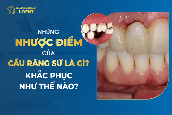 Nhược Điểm Của Cầu Răng Sứ Là Gì? Khắc Phục Như Thế Nào?