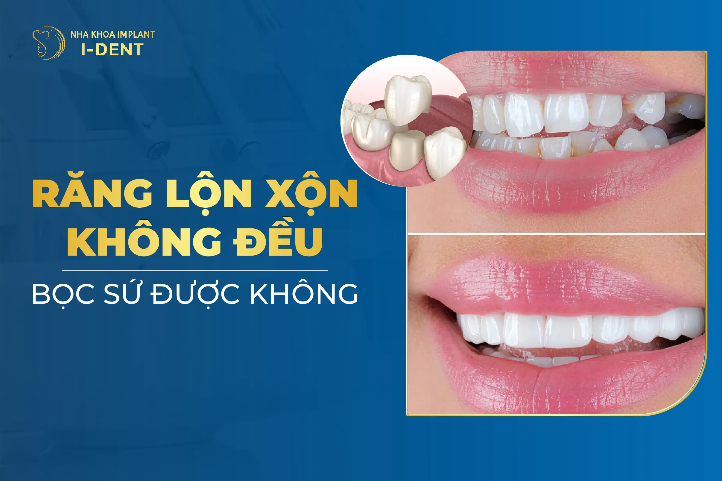 Răng Mọc Lộn Xộn Không Đều Có Bọc Sứ Được Không?